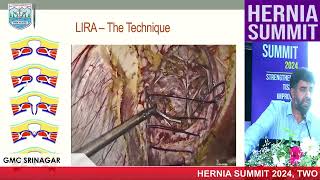 Laparoscopic Intracorporeal Rectus Aponeuroplasty  Dr GM Naikoo Hernia Summit 2024 [upl. by Tavia]