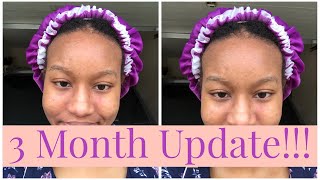 3 Month Metronidazole Cream for Perioral Dermatitis Update  Before and After Photos Included [upl. by Boutis129]