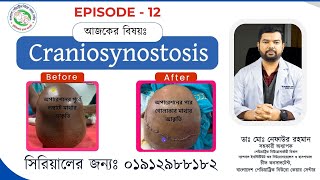 Before After Ep 12  Craniosynostosis Surgery  By Best Paediatric Neurosurgeon Nafaur in Bangladesh [upl. by Elijah]