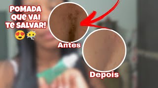 POMADA PARA ESPINHAS ACNE QUE SALVA EM POUCOS DIAS 😍 [upl. by Zashin]