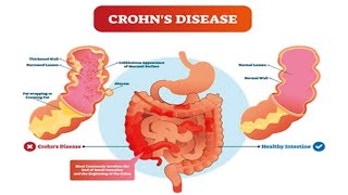 CROHNS DISEASE Definisi Gejala Penyebab Pengobatan Komplikasi dan Pencegahan [upl. by Forward]