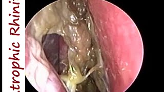 Atrophic Rhinitis Ozaena  Operated Youngs on Left amp Modified Youngs operation on Right [upl. by Elconin114]