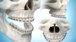 Maxillary Advancement Surgery [upl. by Dareece]