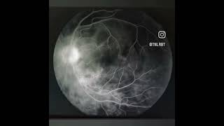 Fundus Fluorescein Angiography of APMPPE MEWDS angiography eye ffa [upl. by Keel741]