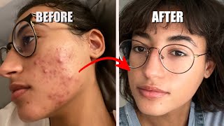 The Skin Care That Cleared My Acne [upl. by Hampton]