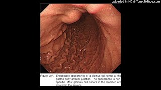 Gastric Neuroendocrine Tumor in a Deep Layer of Submucosa With Diagnosis by Endoscopic UltrasoundGu [upl. by Lieberman]