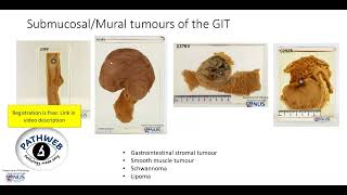 Colon Large intestine Leiomyoma Gross pathology [upl. by Aratas1]