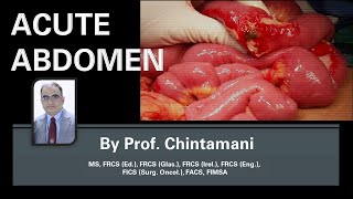 Acute Abdomen  Etiopathogenesis Diagnosis and Management by Prof Chintamani [upl. by Aneleve]