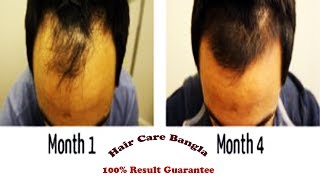 Homeopathic Medicine For Alopecia and Baldness  Hair Care Bangla [upl. by Maryl]