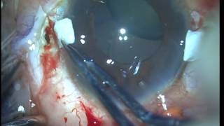 Glued IOL scaffold with Lensectomy Soosan Jacob with audio 2 45 min [upl. by Ayekahs]