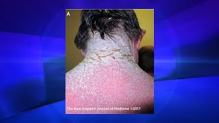 Could This Happen to You Crusted Scabies  The Doctors [upl. by Aynotan837]