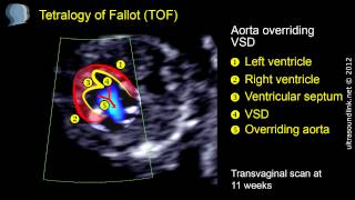 Tetralogy of Fallot TOF echo at 11 weeks [upl. by Uttasta812]