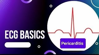 ECG Basics  ECG Changes in Pericarditis  Benign Early Repolarization Vs Pericarditis [upl. by Sandler]