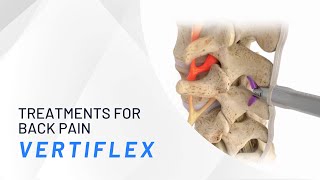 The Vertiflex Procedure  Treatments for Back Pain [upl. by Javler879]