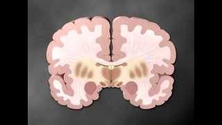 Parkinsons part 1 of 2  Medical Animation by Watermark [upl. by Wesla]