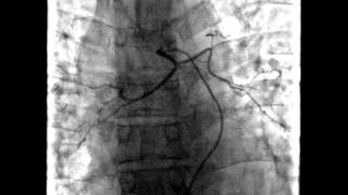 Embolization of bronchial arteries [upl. by Iruy]