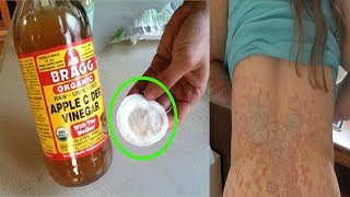 tinea versicolor treatment  how to get rid of tinea versicolor natural treatment [upl. by Yelsnik181]