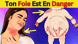 Maladie du foie gras  10 conseils vitaux pour protéger votre santé [upl. by Anilegnave456]