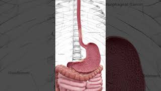 🔬 Understanding Esophageal Cancer Early Detection Is Key 🔬 anatomy [upl. by Norri]