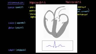 Signs and symptoms of myocarditis and pericarditis [upl. by Huttan]