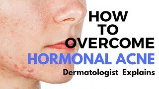 Skin Care Tips Treating HORMONAL ACNE [upl. by Laersi173]