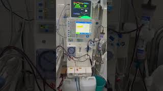 Hyperkalemia patient ka dialysis  CKD patient stage  V  hyperkalemia dialysis hemodialysis [upl. by Milman]