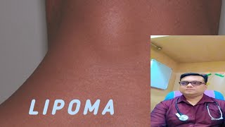 LIPOMA kya hota hai Lipoma symptoms [upl. by Pasco267]