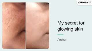 quotIn Just 15 Days I Noticed a Remarkable Improvementquot  Anshu  Cureskin review [upl. by Oah187]