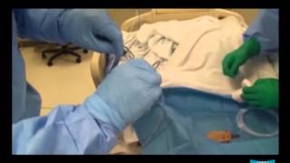 Percutaneous Endoscopic Gastrostomy pull method and Jejunal Extension Tube Placement [upl. by Annehcu]