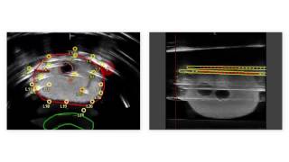 Realtime Prostate Solutions for treating prostate cancer with brachytherapy [upl. by Gruchot]