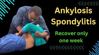 Ankylosis Spondylitis Recover Only One Week ankylosing spondylitis symptoms treating ankylosing [upl. by Claudetta177]