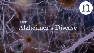 Inside Alzheimer’s disease [upl. by Fontana]