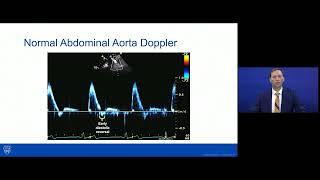 Coarctation of aorta Infantile type vs adult type mnemonic [upl. by Llenrev]