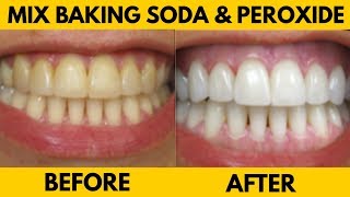 Hydrogen Peroxide Teeth Whitening  Mix Baking Soda amp Hydrogen Peroxide for Whiter Teeth [upl. by Annauj]