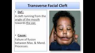 Developmental Disturbances of The Soft Tissues part1Oral Pathologywmv [upl. by Sudnor]