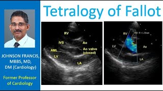 Tetralogy of Fallot [upl. by Nnylkoorb]