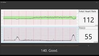 Fetal Heart Monitoring [upl. by Mccully]