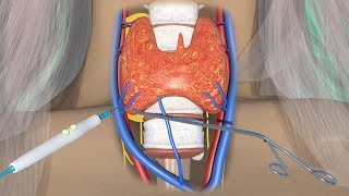 3D Medical animation Parathyroidectomy Cure with Minimally Invasive surgery [upl. by Neik]