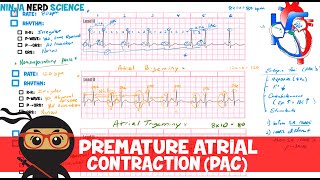 Rate and Rhythm  Premature Atrial Contraction PAC [upl. by Latsyrhk934]