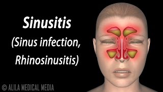 Sinusitis Animation [upl. by Ahc810]