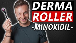 How To Use Derma Roller and Minoxidil to Regrow Hair [upl. by Ahusoj991]