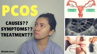 PCOS  Causes Symptoms Treatment  Tagalog [upl. by Ardnikal]