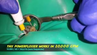 using power flosser waterpik with endoactivator tip to agitate endodontic irrigating solution [upl. by Ynnot]