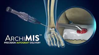 ArchiMIS  Precision Autograft Delivery  Launch Video [upl. by Bendicta]