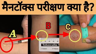 mantoux test in hindi मैनटॉक्स टेस्ट  Mantoux Test in Hindiasmedico [upl. by Esaertal786]