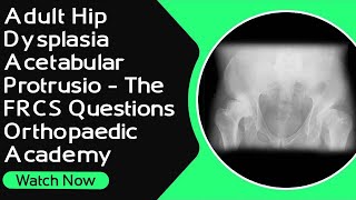 Adult Hip Dysplasia  Acetabular Protrusio  The FRCS Questions। Orthopaedic Academy [upl. by Eelra429]