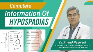 Complete Information about Hypospadias in Kolkata Hindi  वयस्क अधोमूत्रमार्गता  Dr Nagwani [upl. by Oidivo]