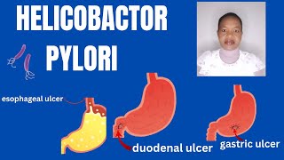 What you need to know about Helicobacter Pylori infectionHpylori [upl. by Anelleh]