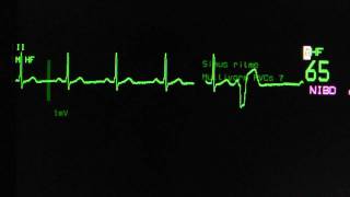 sinus rhythm with ventricular extrasystoles on an ECG monitor [upl. by Ecirpak799]