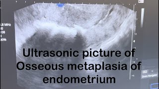 Ultrasound picture of Osseous metaplasia of endometrium [upl. by Einnos]